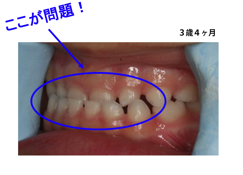 幼児の矯正歯科